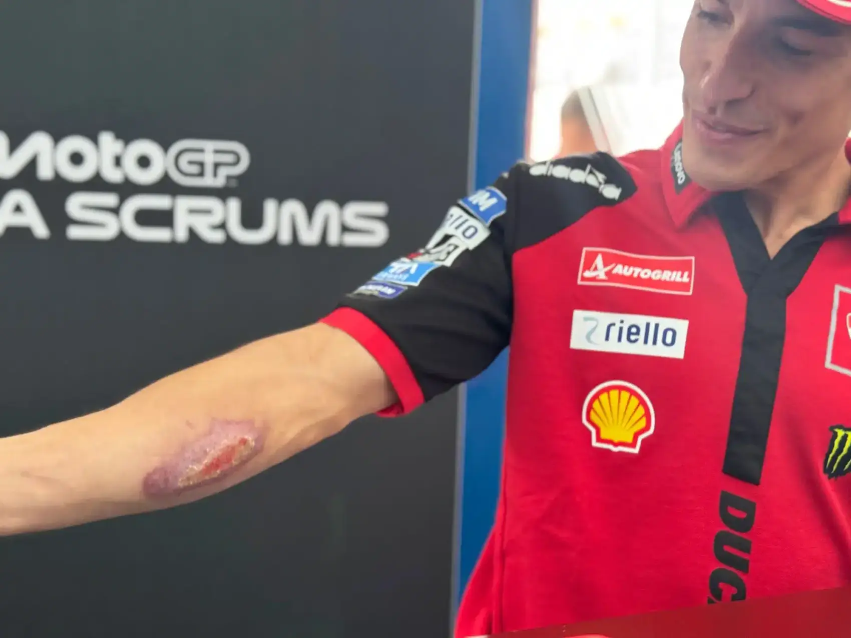 Felfedte és meg is mutatta titkolt sérülését Marc Márquez
